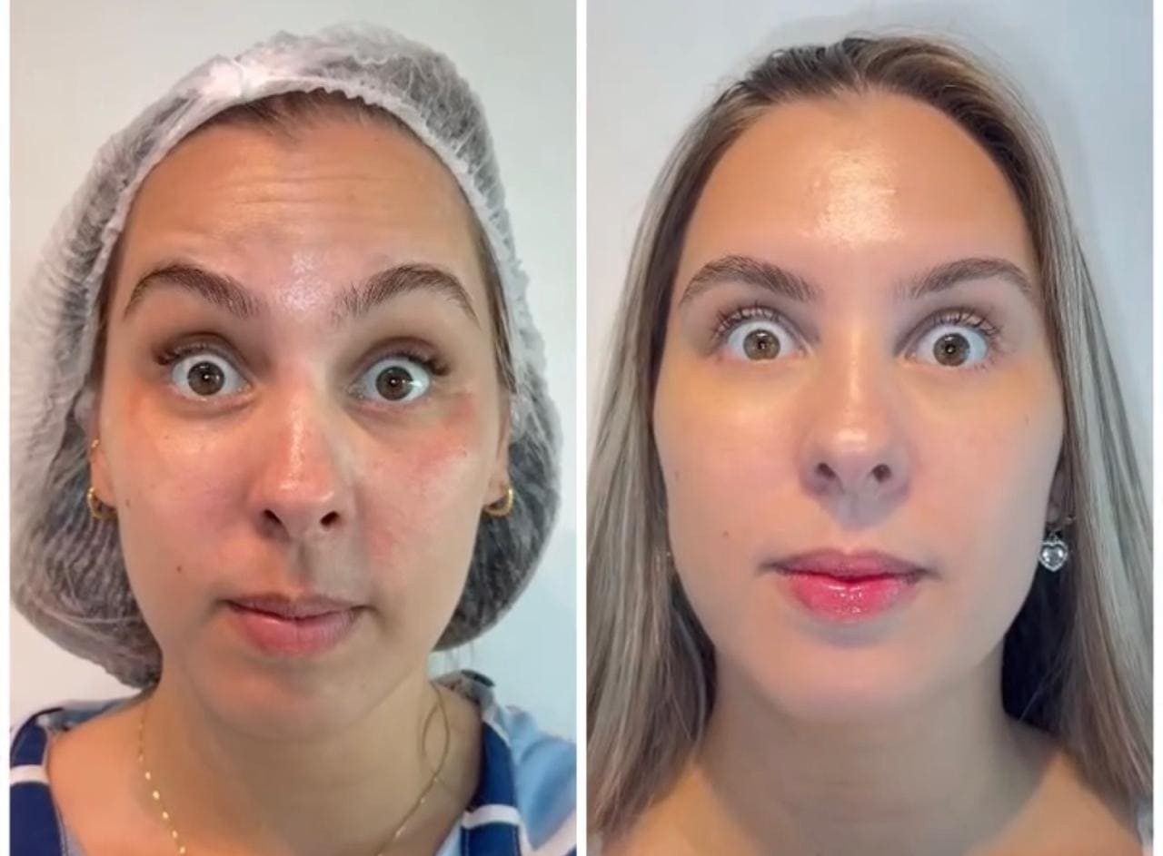 Aplicação de Toxina Botulínica