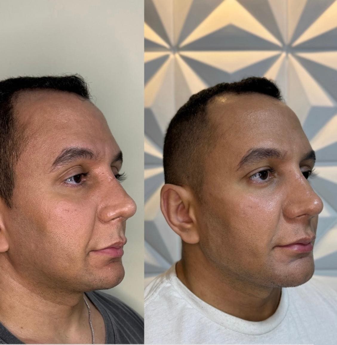 Harmonização Facial