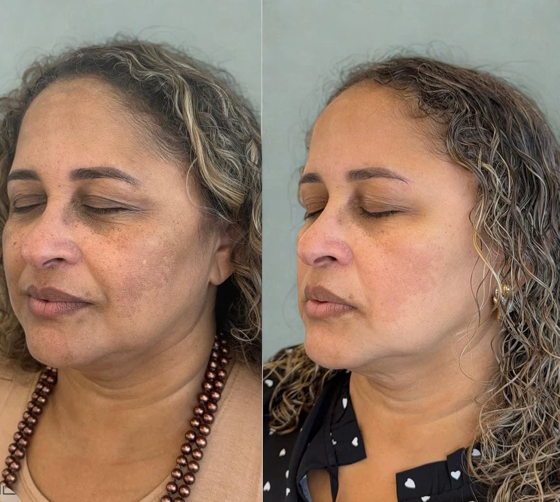 Gerenciamento de Melasma